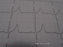 EKG